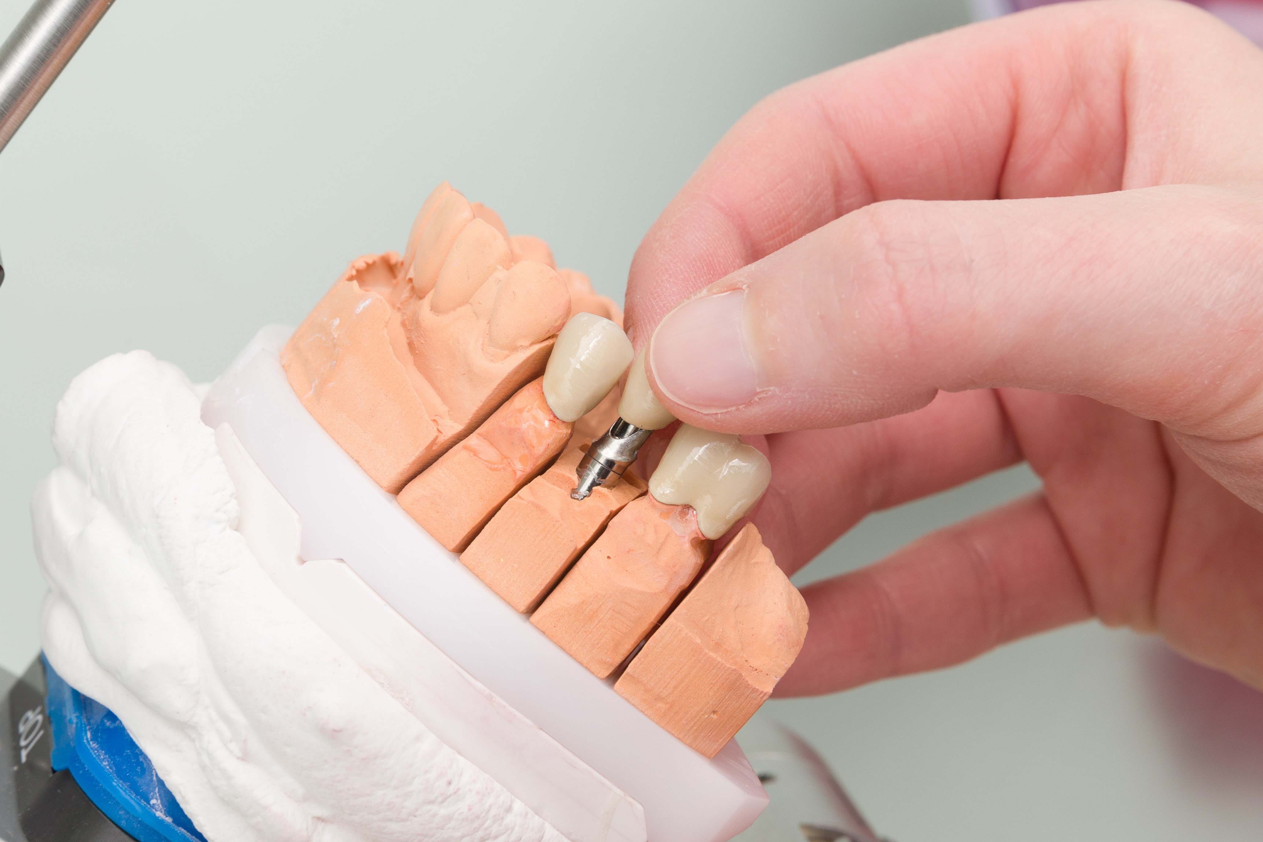 Hochwertiger Zahnersatz